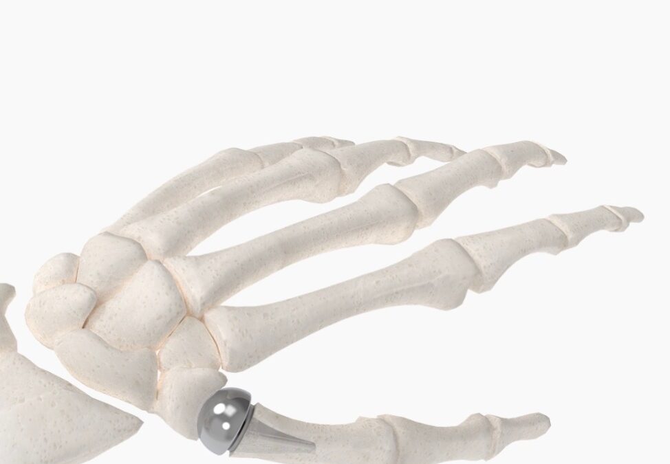 A New Option for Thumb Arthritis Relief: Dr. Tarr Performs First Biopro Thumb CMC Implant in North Carolina