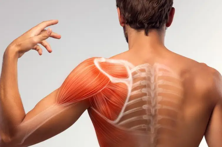 What is Shoulder Bursitis?