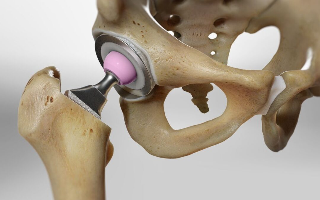 Reclaiming Your Mobility: Common Questions about Hip Arthroplasty
