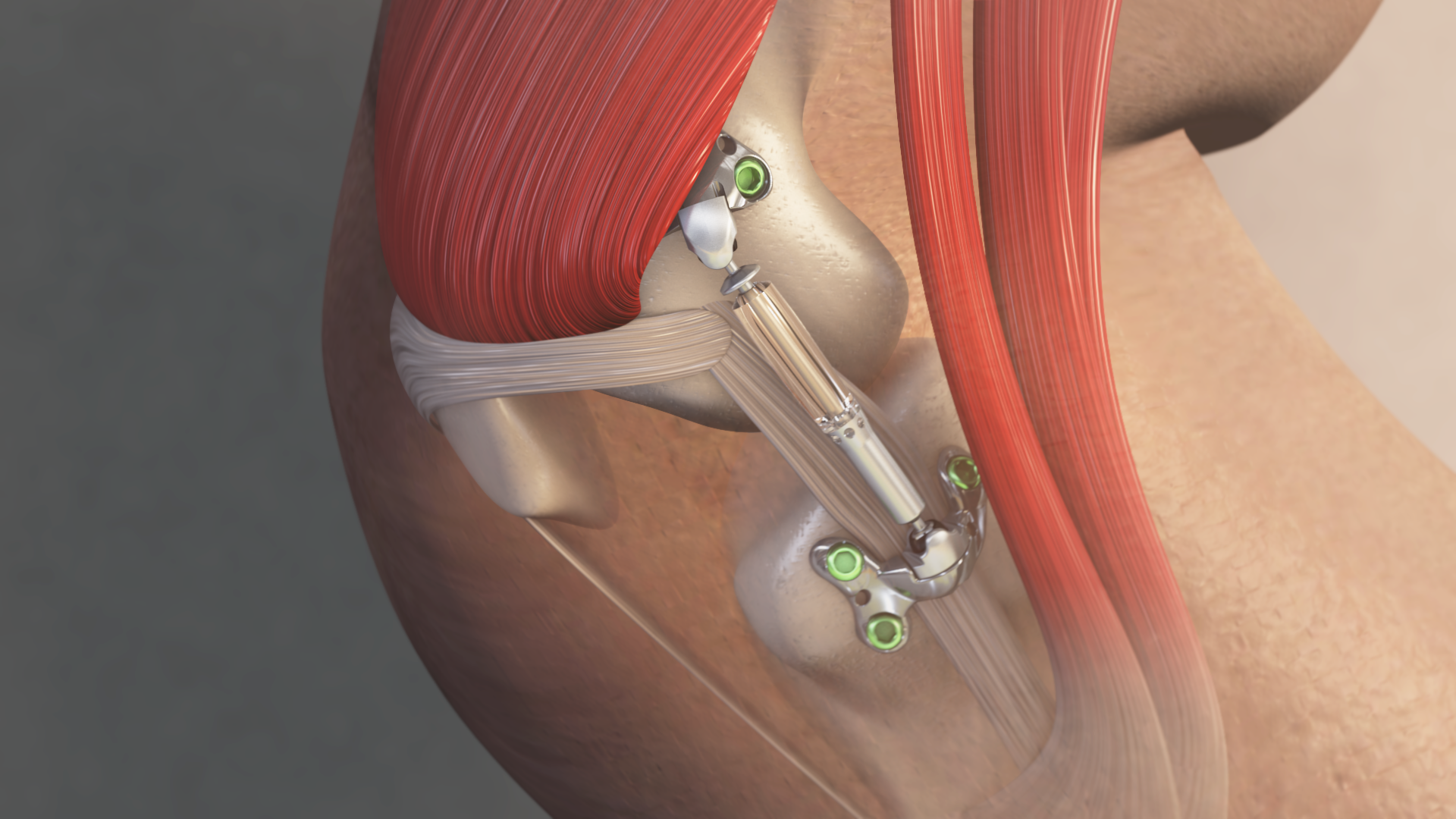 B. Product Image 2 - MISHA Knee System